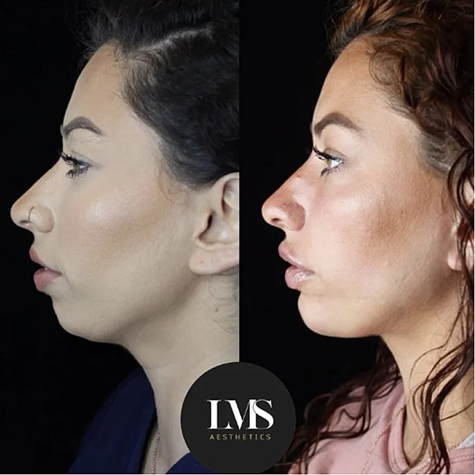 Before and after aesthetic treatment comparison.